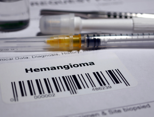 Difference Between Hematoma and Hemangioma (1)