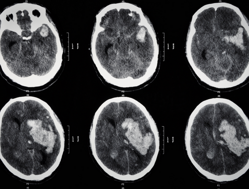 Difference Between Brain Hematoma and Brain Hemorrhage