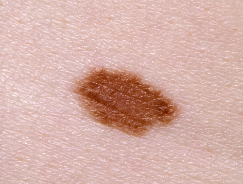 Difference Between Hematoma and Melanoma