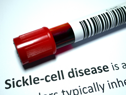 Difference Between Malaria and Sickle Cell Anemia
