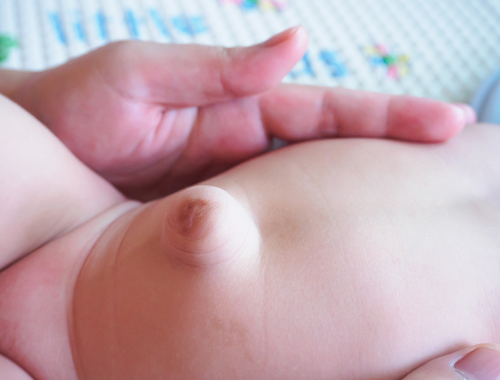 Difference Between Umbilical Granuloma and Hernia (1)