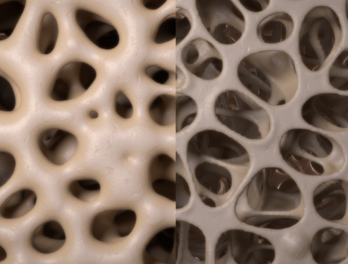 Difference Between Osteoporosis and Osteopenia (1)