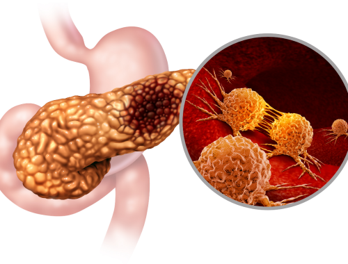 Difference Between Pancreatitis and Pancreatic Cancer (1)