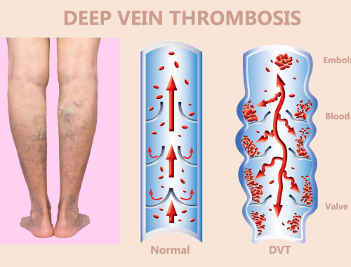 Difference Between Pulmonary Embolism and Deep Vein Thrombosis (2)