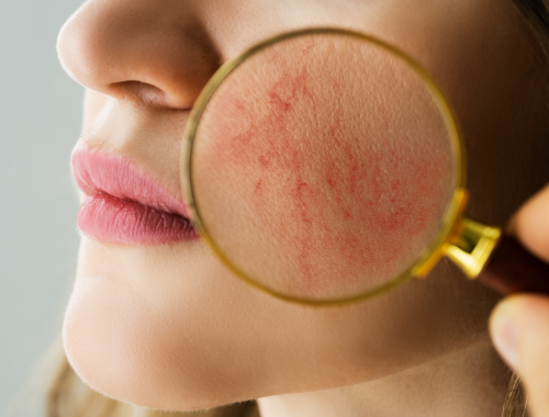 Difference Between Acne Rosacea and Acne Vulgaris