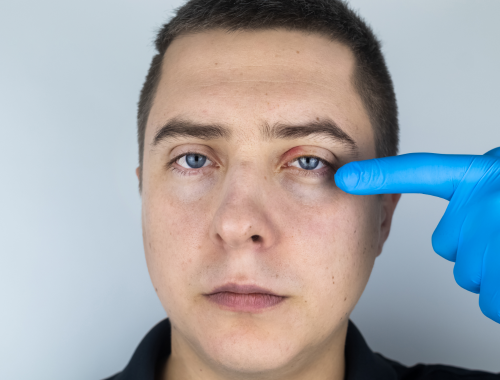 Difference Between Blepharitis and Chalazion