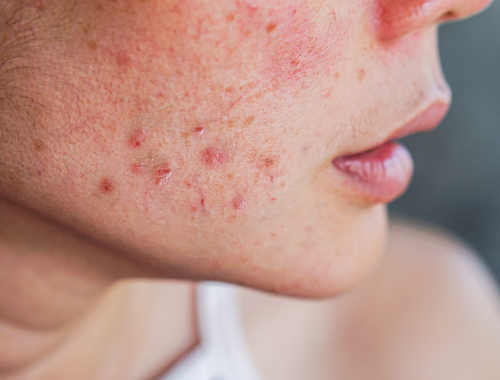 Difference Between Rosacea and Butterfly Rash