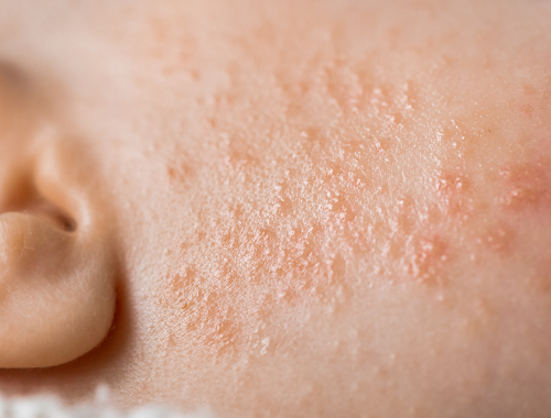 Difference Between Rosacea and Malar Rash (3)