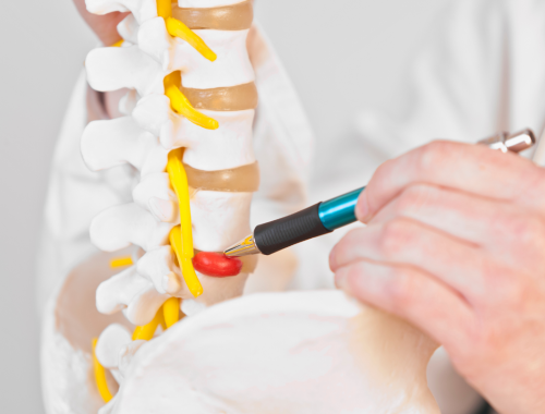Difference Between Sciatica and Herniated Disc