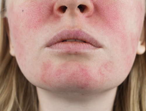 Difference Between a Lupus Rash and Rosacea