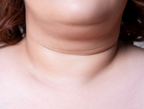 Difference Between Goiter and Fat Neck (1)