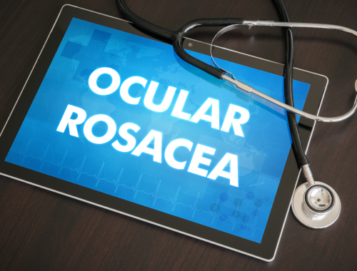 Difference Between Ocular Rosacea and Blepharitis (1)