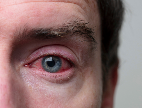 Difference Between Ocular Rosacea and Blepharitis
