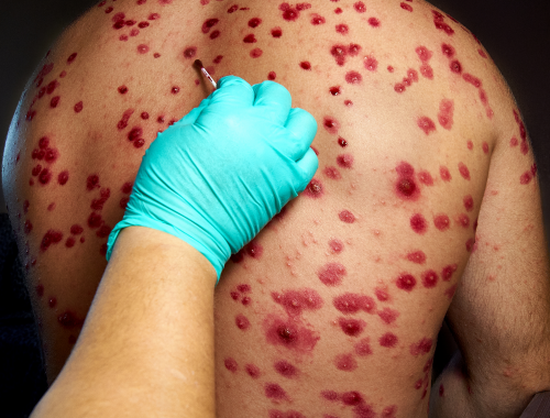 Difference Between Ramsay Hunt Syndrome and Shingles