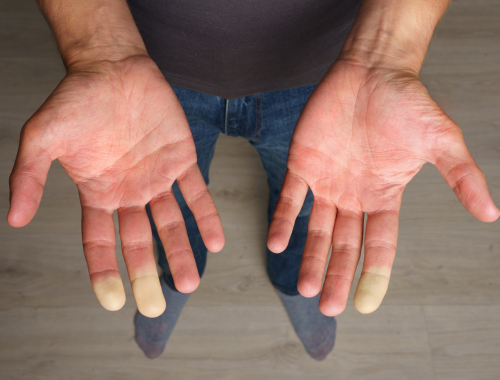 What Triggers Raynaud's Disease Difference Between Raynaud's Syndrome and Disease (1)