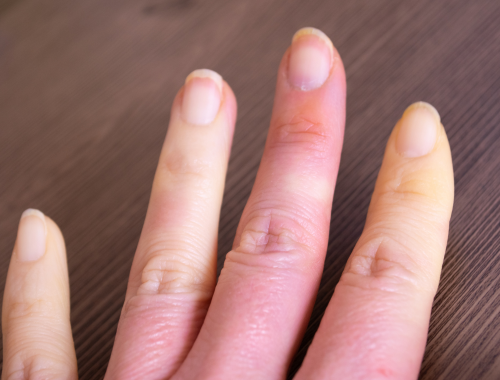 What Triggers Raynaud's Disease Difference Between Raynaud's Syndrome and Disease