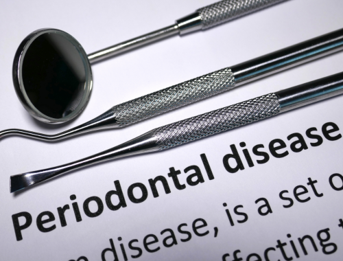 Difference Between Pericoronitis and Periodontitis (1)