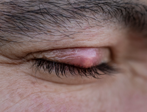 Difference Between Hordeolum and Chalazion