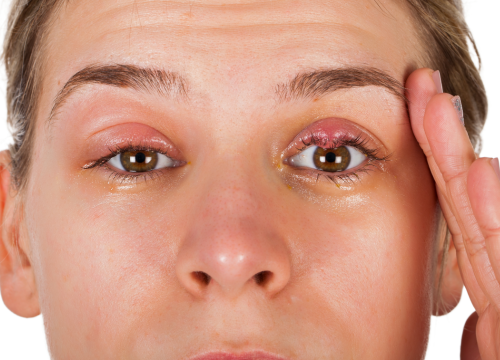 Difference Between Hordeolum and Chalazion and Blepharitis (1)