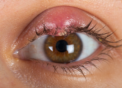 Difference Between Hordeolum and Chalazion and Blepharitis (2)