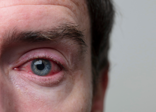 Difference Between Hordeolum and Chalazion and Blepharitis